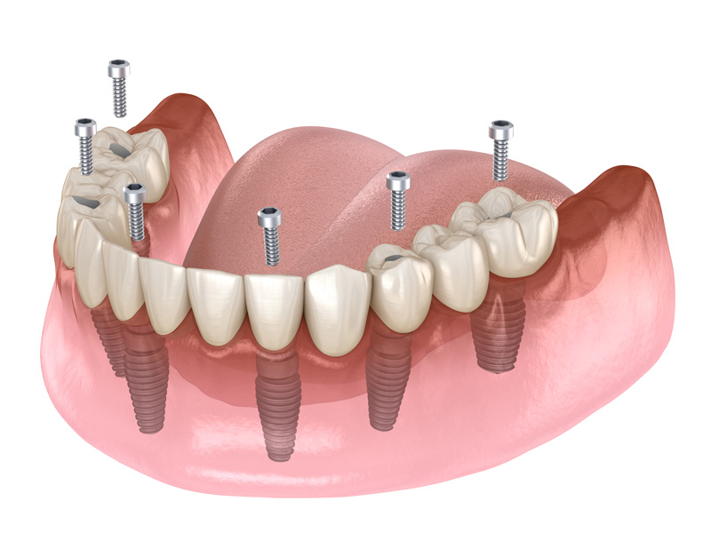 diagram of All-On-4 Implant with screws