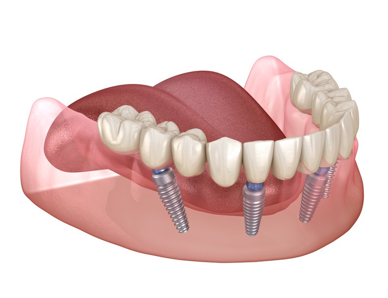 diagram of All-On-4 Implant